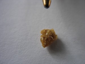 Kidney Stone