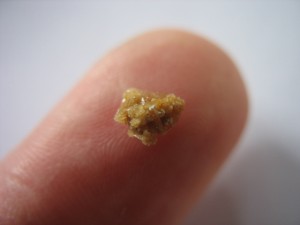 My Kidney Stone!
